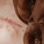tetron fabric medical applications